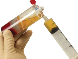 Platelet Rich Plasma (PRP)